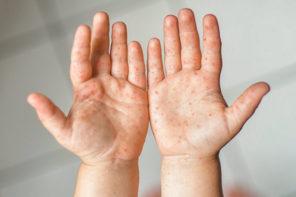 hand-food-mouth-disease-sbcc hand-food-mouth-disease-sbcc